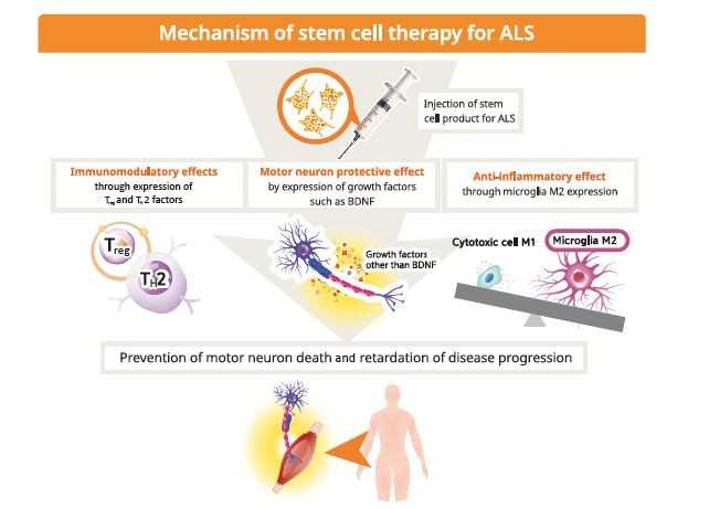 The Future of Stem Cell Therapy in ALS