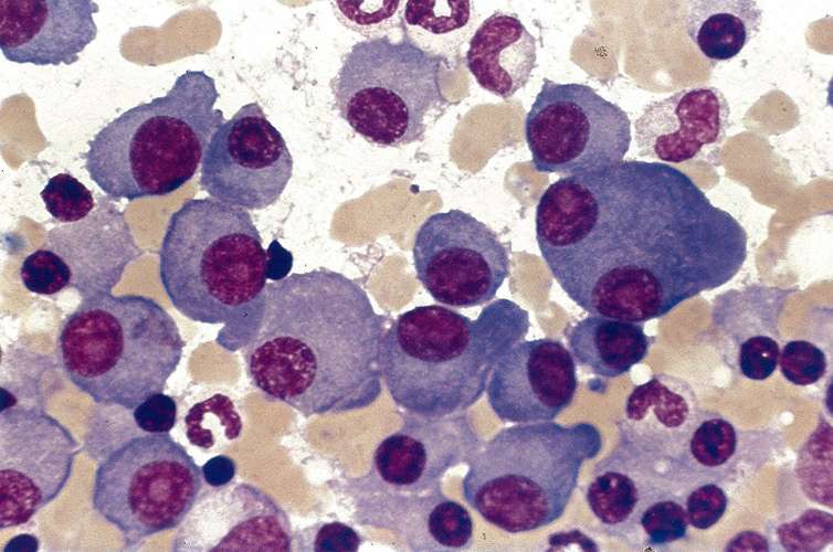 Clusters of plasma cells in multiple myeloma