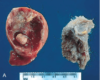 Gross appearance of an opened cystic teratoma of the ovary