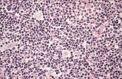 Hodgkin lymphoma, lymphocyte predominance type