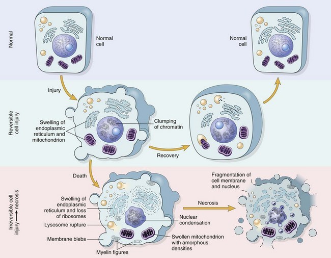 Schematic representation of a normal cell and the changes in reversible and irreversible cell injury