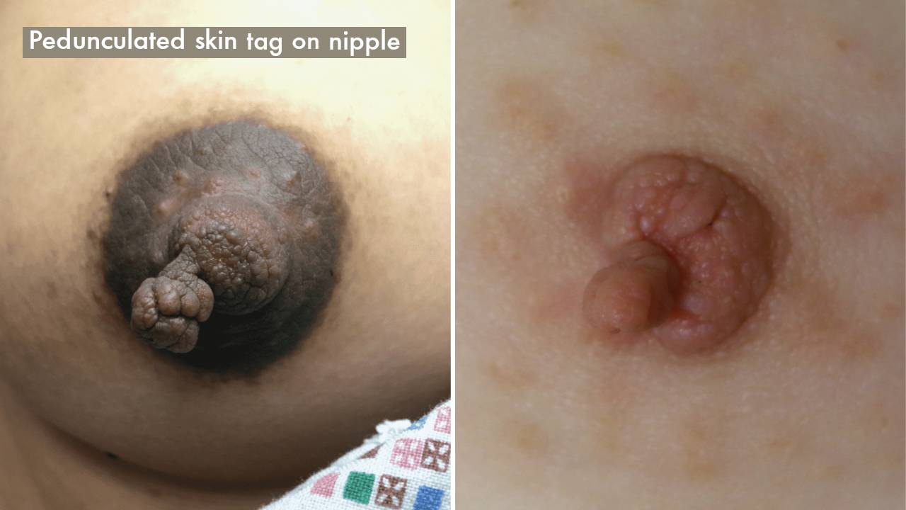 Pedunculated skin tag on nipple