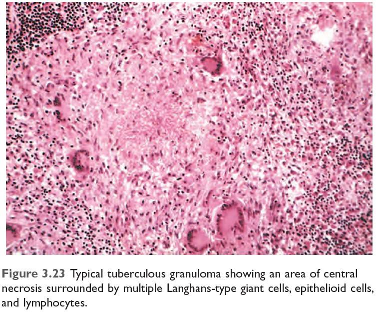 Tuberculosis Granuloma