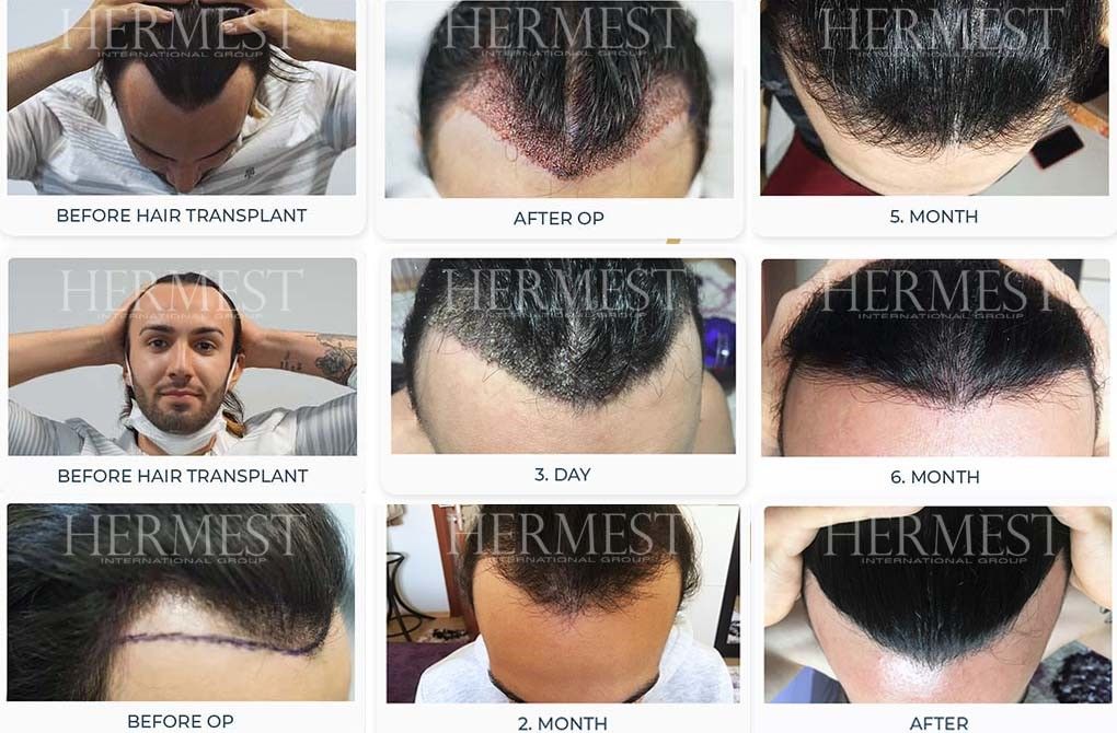 Unshaved hair transplant process in Turkey