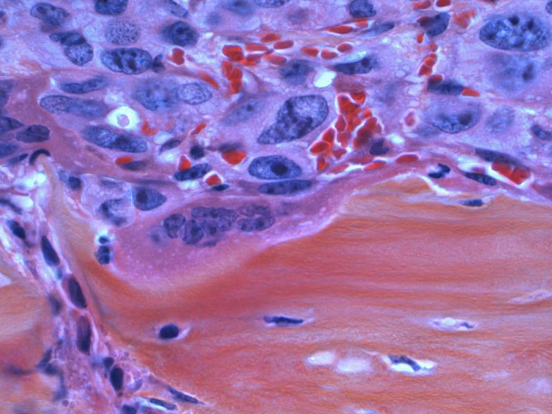 Hematologic Malignancies: A Comprehensive Overview