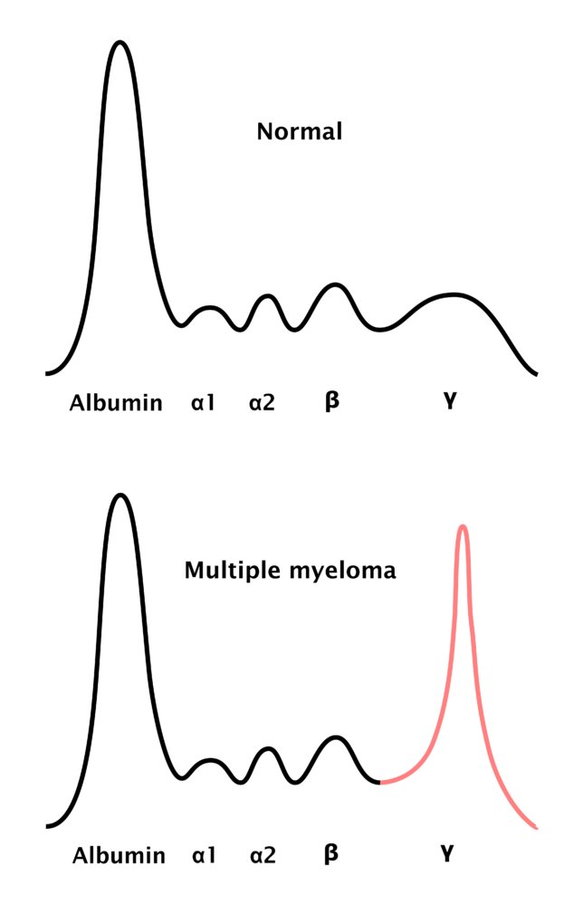 Electrophoresis in multiple myeloma