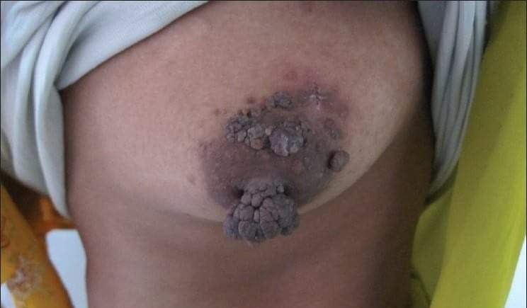 Pedunculated skin tag on nipple