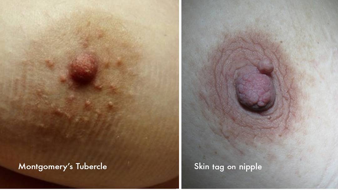 Difference between Montgomery tubercles and skin tag on nipple