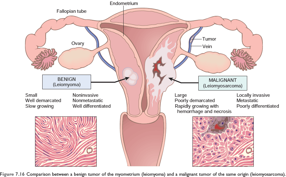 Comparison between a benign tumor of the myometrium (leiomyoma) and a malignant tumor of the same origin (leiomyosarcoma)