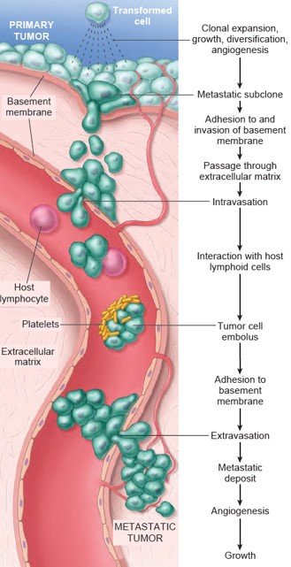 Metastatic cascade. Sequential steps are involved in the hematogenous spread of a tumor robbin