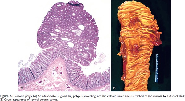 Colonic polyp