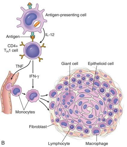 Mechanism of granuloma formation Robbins