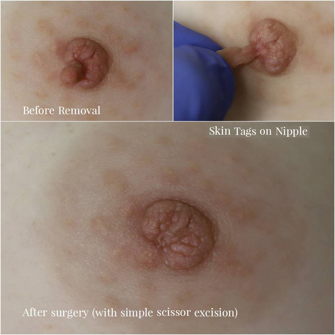 Before & after removal of skin tag on nipple 