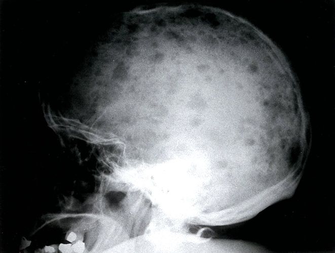 Osteolytic lesion in multiple myeloma