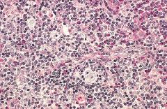 Hodgkin lymphoma, mixed-cellularity type