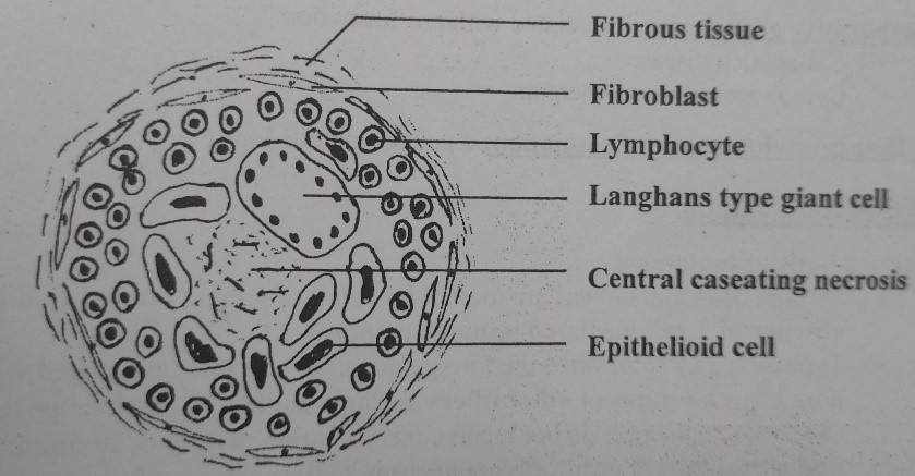 Histology of Granuloma