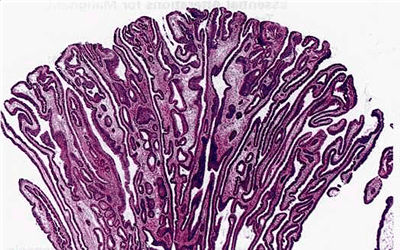 Papilloma of the colon with finger-like projections into the lumen