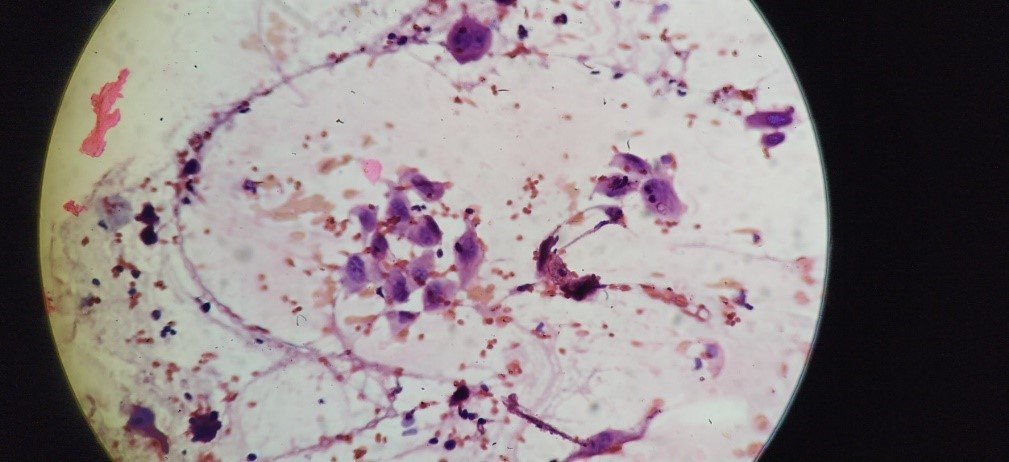 Malignant cell in Pap stain