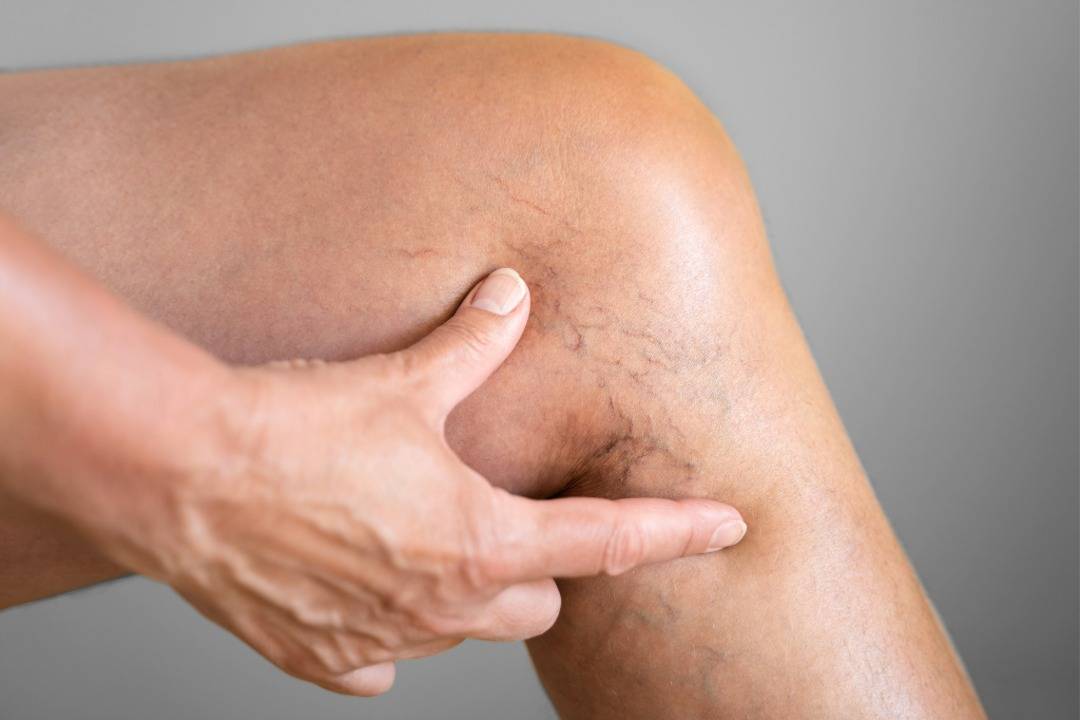 How to Choose a Vein Specialist: Credentials That Matter