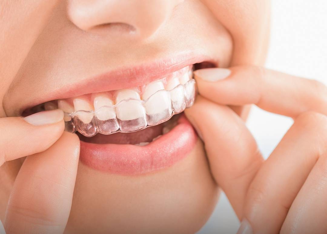 My Journey with Tooth Aligners: How a Simple Smile Fix Changed Everything
