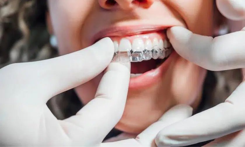 What to Expect During Your Invisalign Treatment