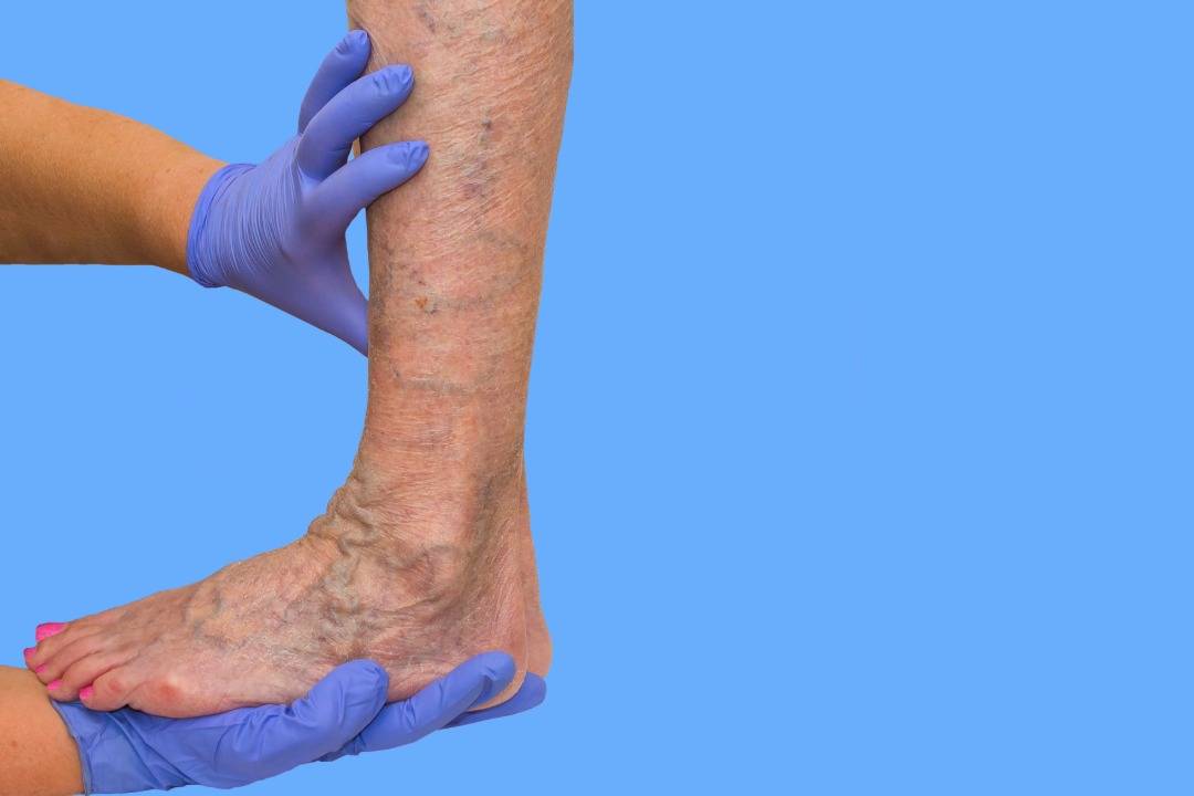 Recovery After Varicose Vein Treatment: What to Know