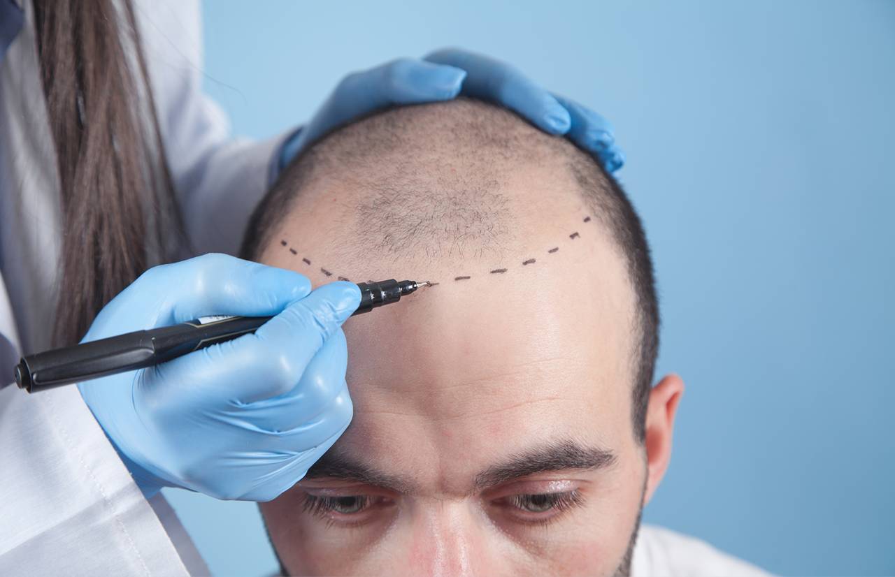 Why More Australians are Seeking Direct Follicle Insertion Hair Restoration