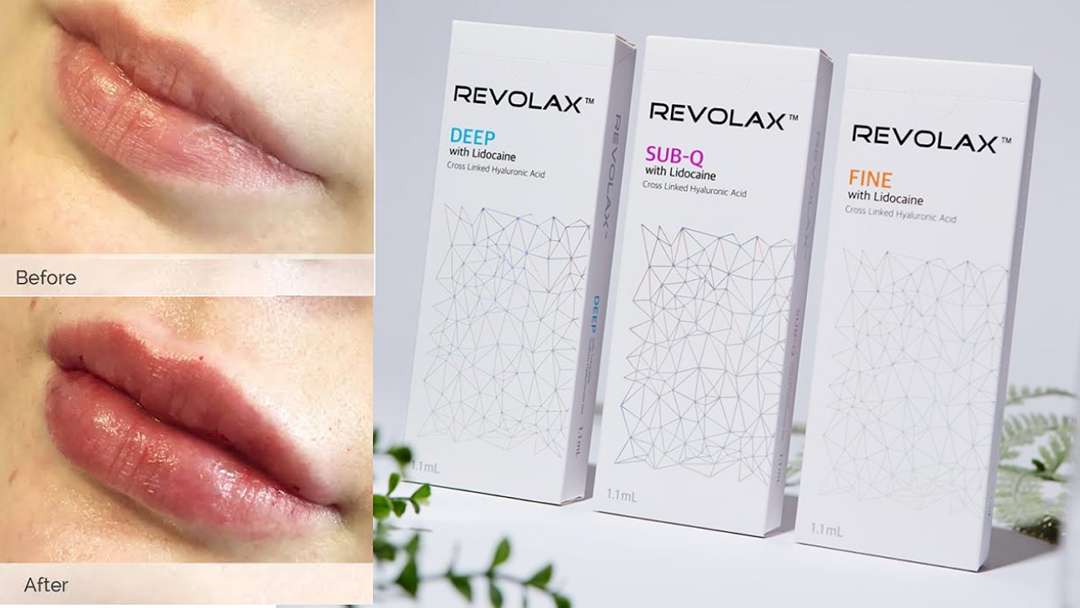 How long do Revolax lip fillers last
