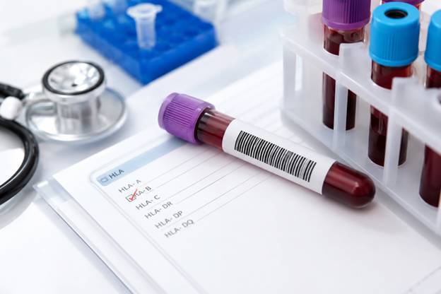 What is an HLA-B27 Test? Uses, Risks, and Results