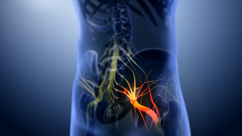 What Are Some Home Remedies for Your Sciatic Nerve Pain