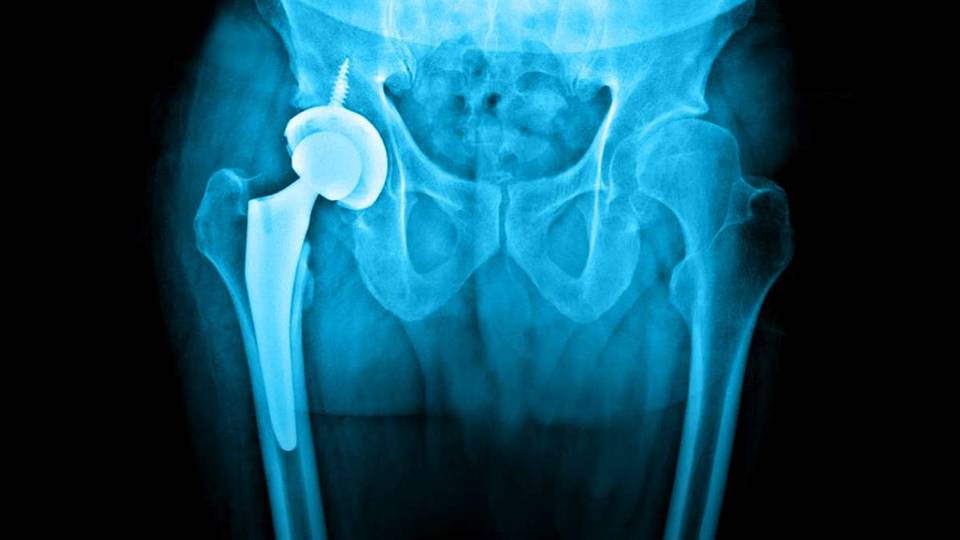 Understanding The Benefits Of Hip Orthopedic Surgery - Emedicodiary