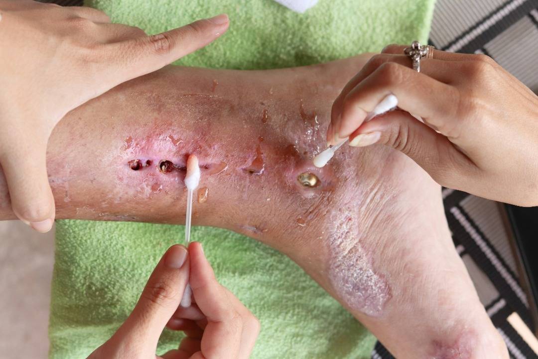 How to Tell If a Cut Is Infected?