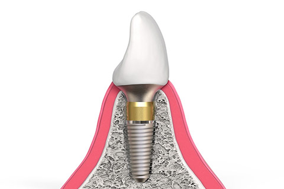 What to Look for in a Quality Implant Provider?