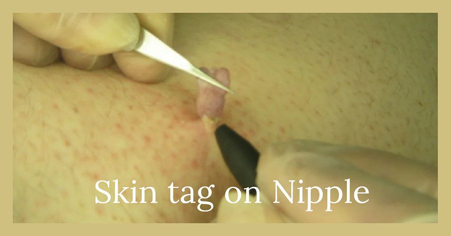 Skin tag on nipple