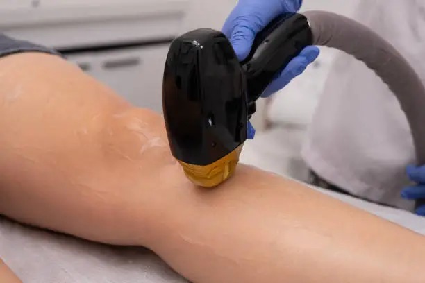 What Makes Laser Hair Removal a Long-Term Solution?