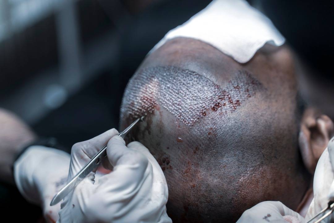 Top 7 Best Hair Transplant Doctors in Turkey 2026