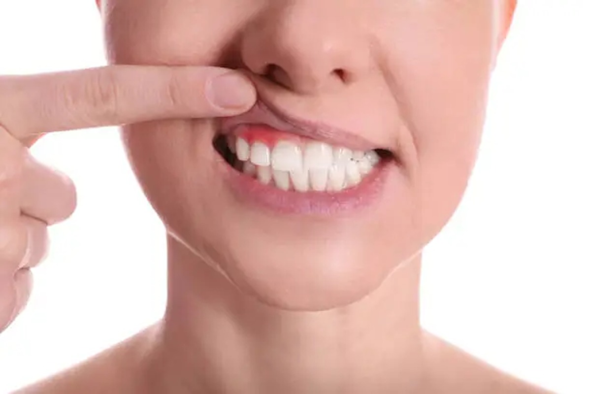 How Can You Treat Gingivitis Before It Turns Into Periodontitis?