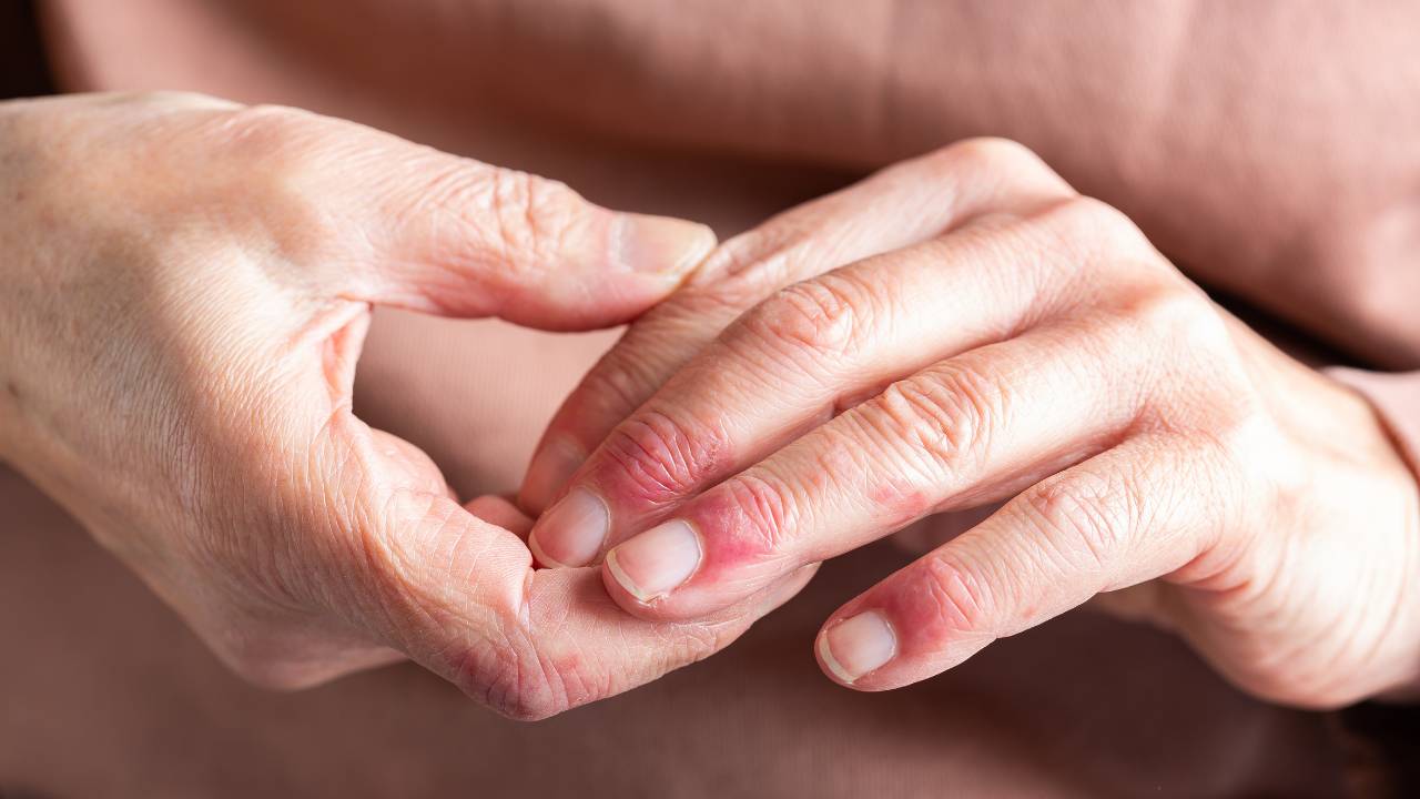 8 Tips to Live Your Best with Psoriatic Arthritis
