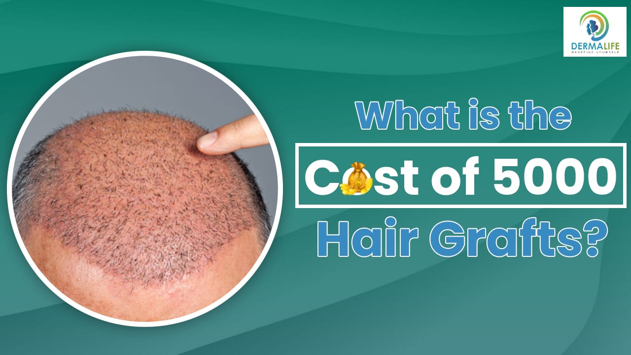 Is ₹2 Lakh Enough for a Hair Transplant in Delhi?