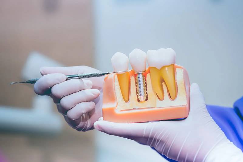 Dental Implant Surgery