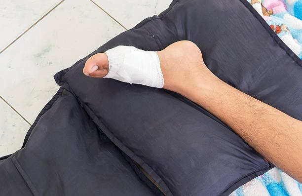 How Untreated Lisfranc Injuries Can Affect Your Mobility and Life