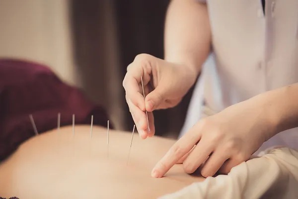 Needle Away Your Infertility Woes: Understanding Acupuncture for Reproductive Health