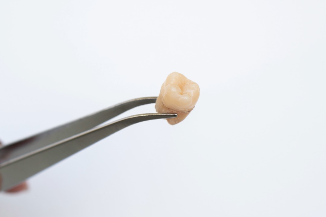 Do Wisdom Teeth Always Need to Be Removed?