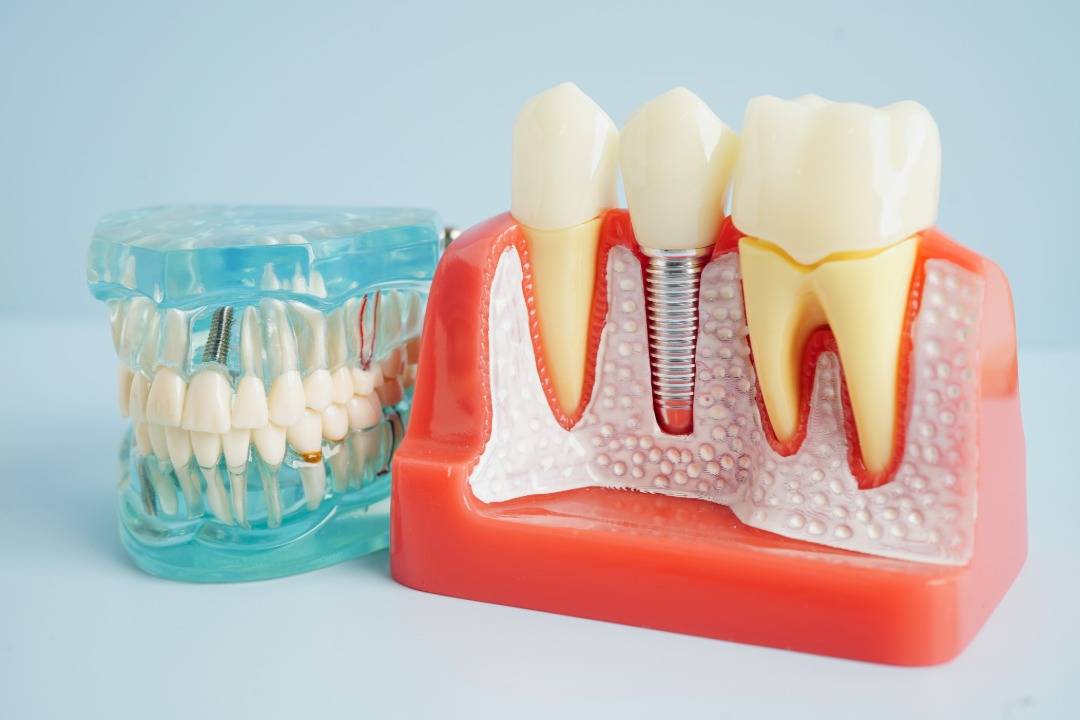 Simplifying the Dental Implant Market: Why Compatibility Across 200+ Brands Matters for Clinicians
