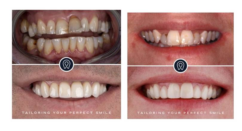 Combining Cosmetic Dentistry Procedures for a Complete Smile Makeover