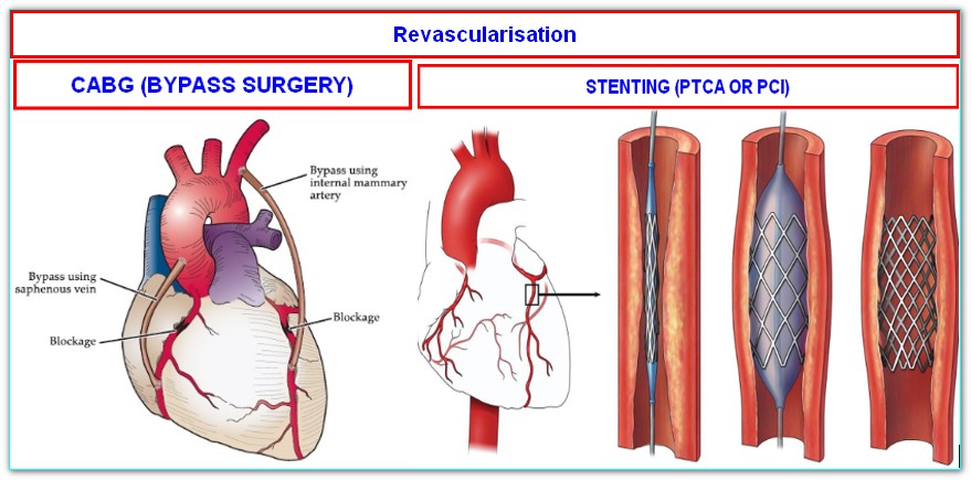 Angioplasty vs Bypass Surgery: Which is Safer for Heart Patients?