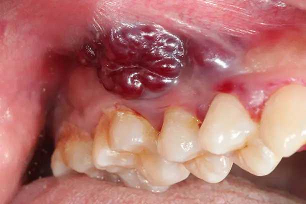 Numbness in the Tongue or Lip That Won’t Resolve – Is It Oral Cancer?