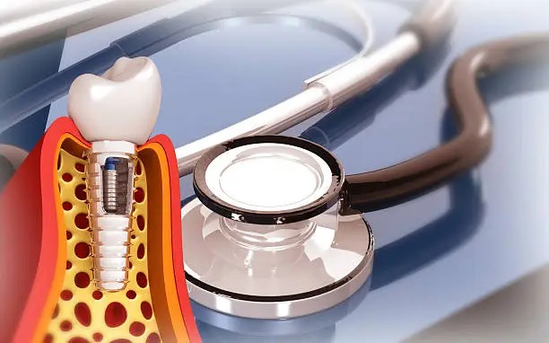 What Happens If You Don’t Replace a Missing Tooth? Long-Term Effects on Your Oral Health