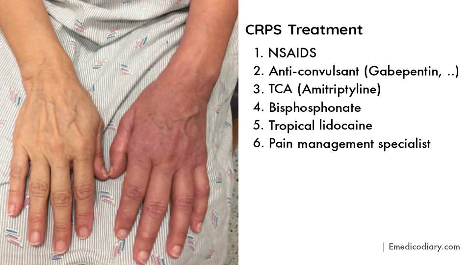CRPS Treatment