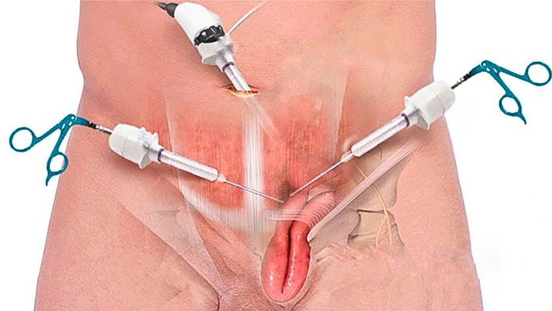 Your Guide to Inguinal Hernia Repair in Los Angeles